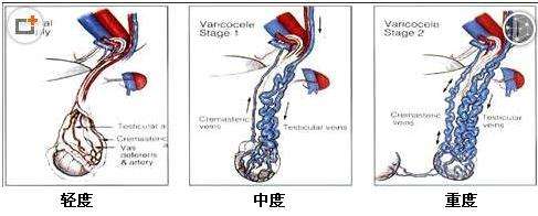 苏州治疗精索静脉曲张医院