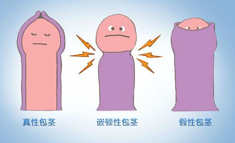 苏州治疗包茎医院