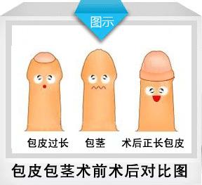 苏州包皮手术较好的医院
